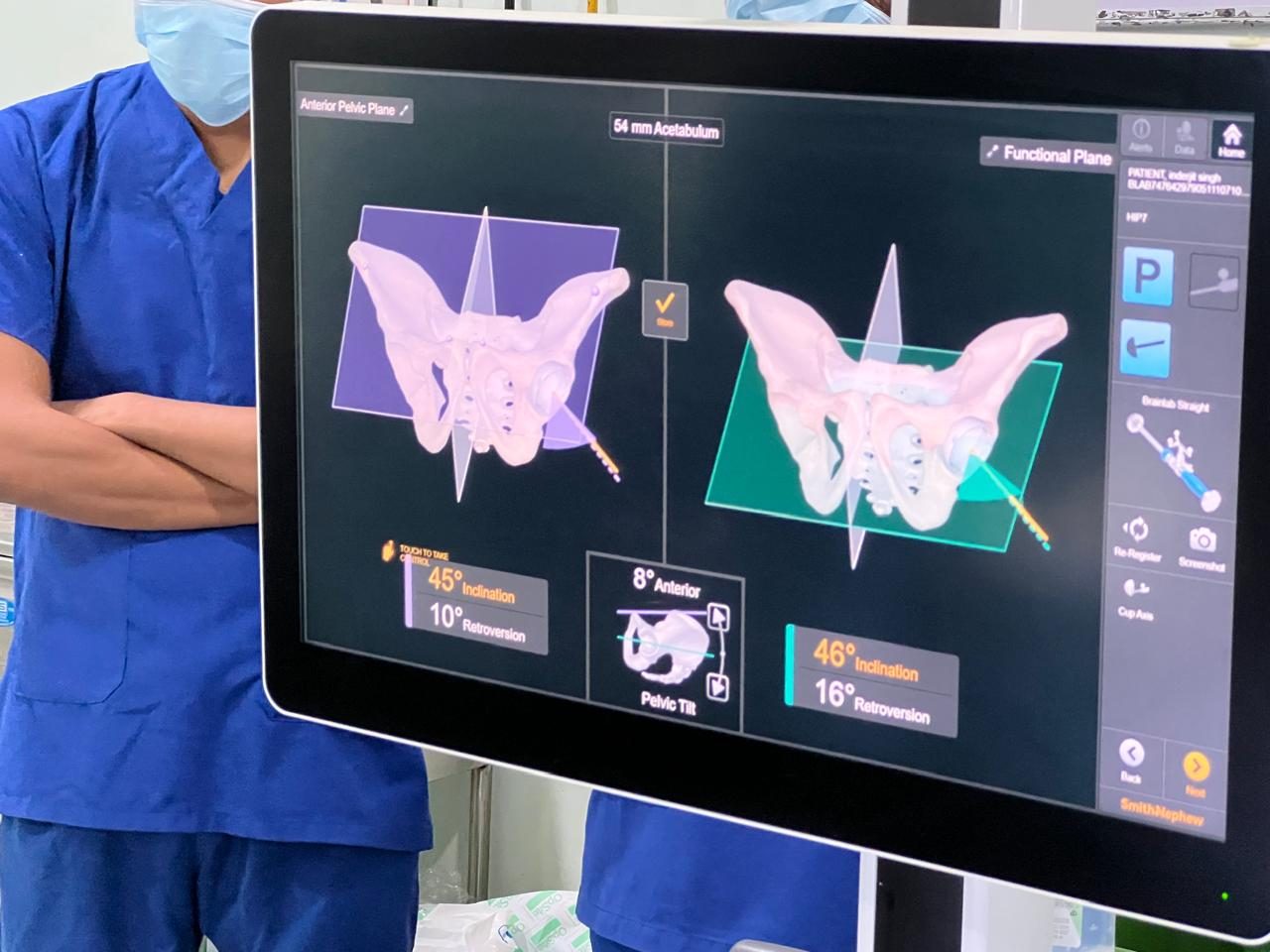 Robotic navigation screen showing 3-D hip planning